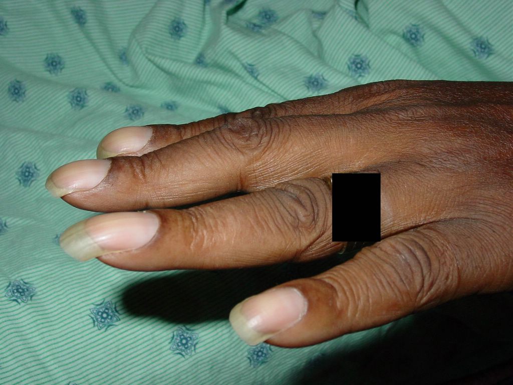 CasesBlog - Medical and Health Blog: Case of the Week: Finger Clubbing